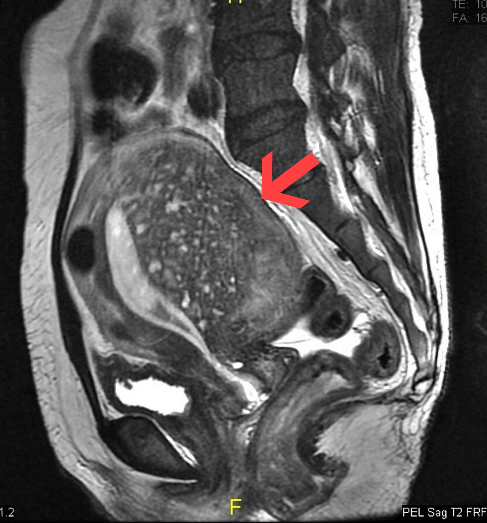 High-resolution sagittal pelvic MRI radiology scan showing uterine wall and pelvic cavity
