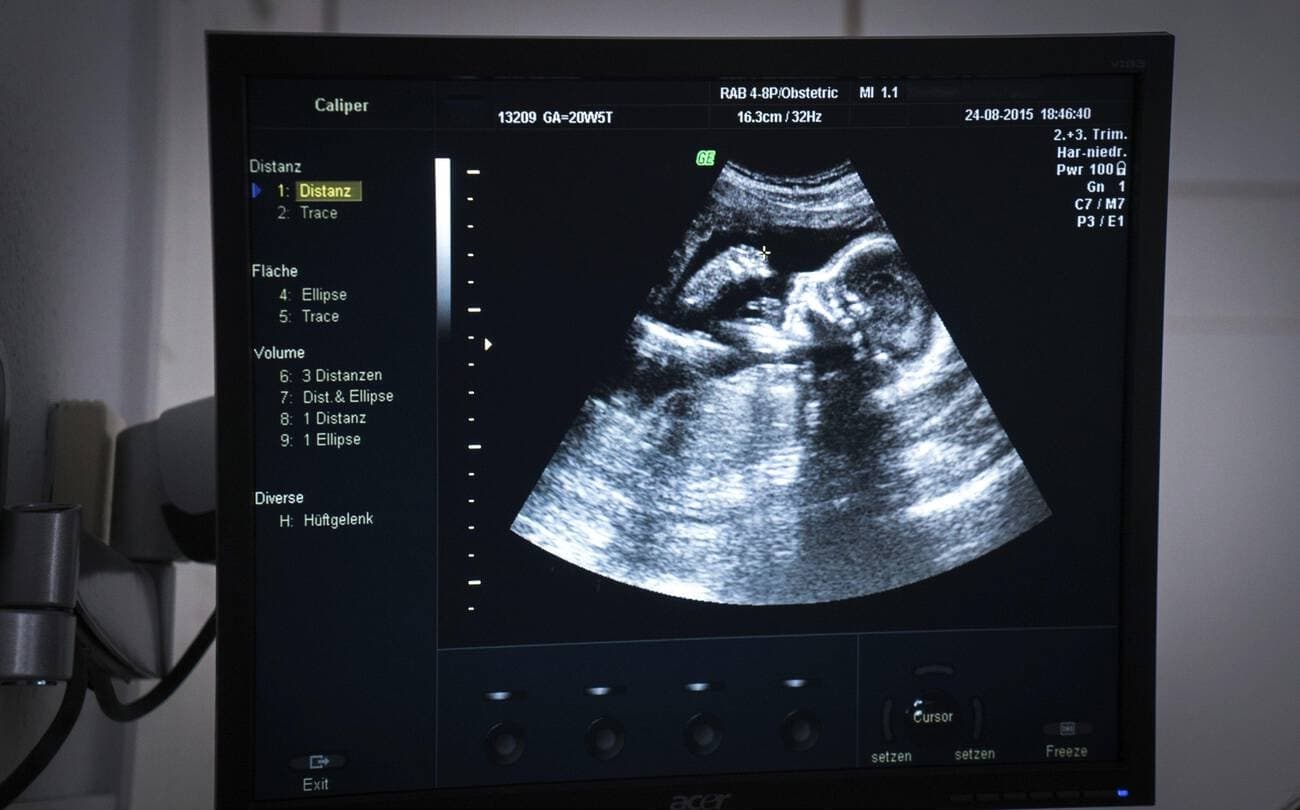 Authentic clinical 2D obstetric ultrasound scan showing fetal anatomical profile